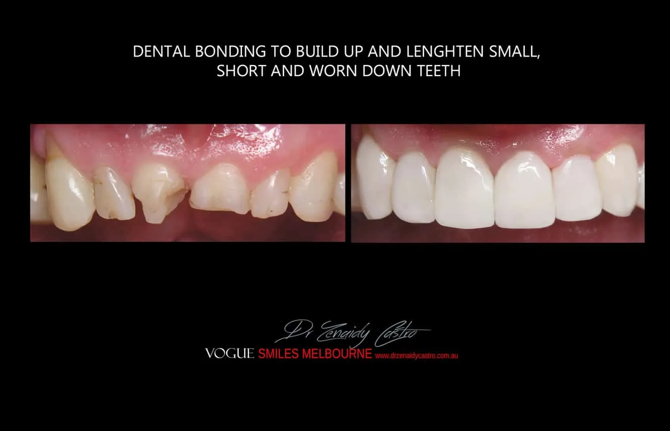 Is there a cheaper option than veneers?- Composite Veneers, Dental Bonding Melbourne CBD and Noble Park North