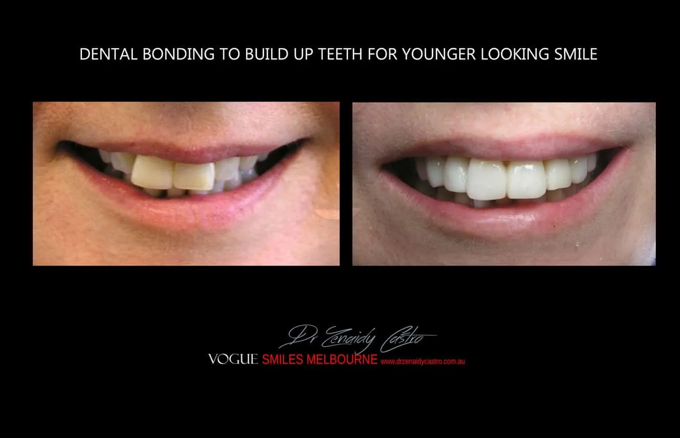 Is there a cheaper option than veneers?- Composite Veneers, Dental Bonding Melbourne CBD and Noble Park North