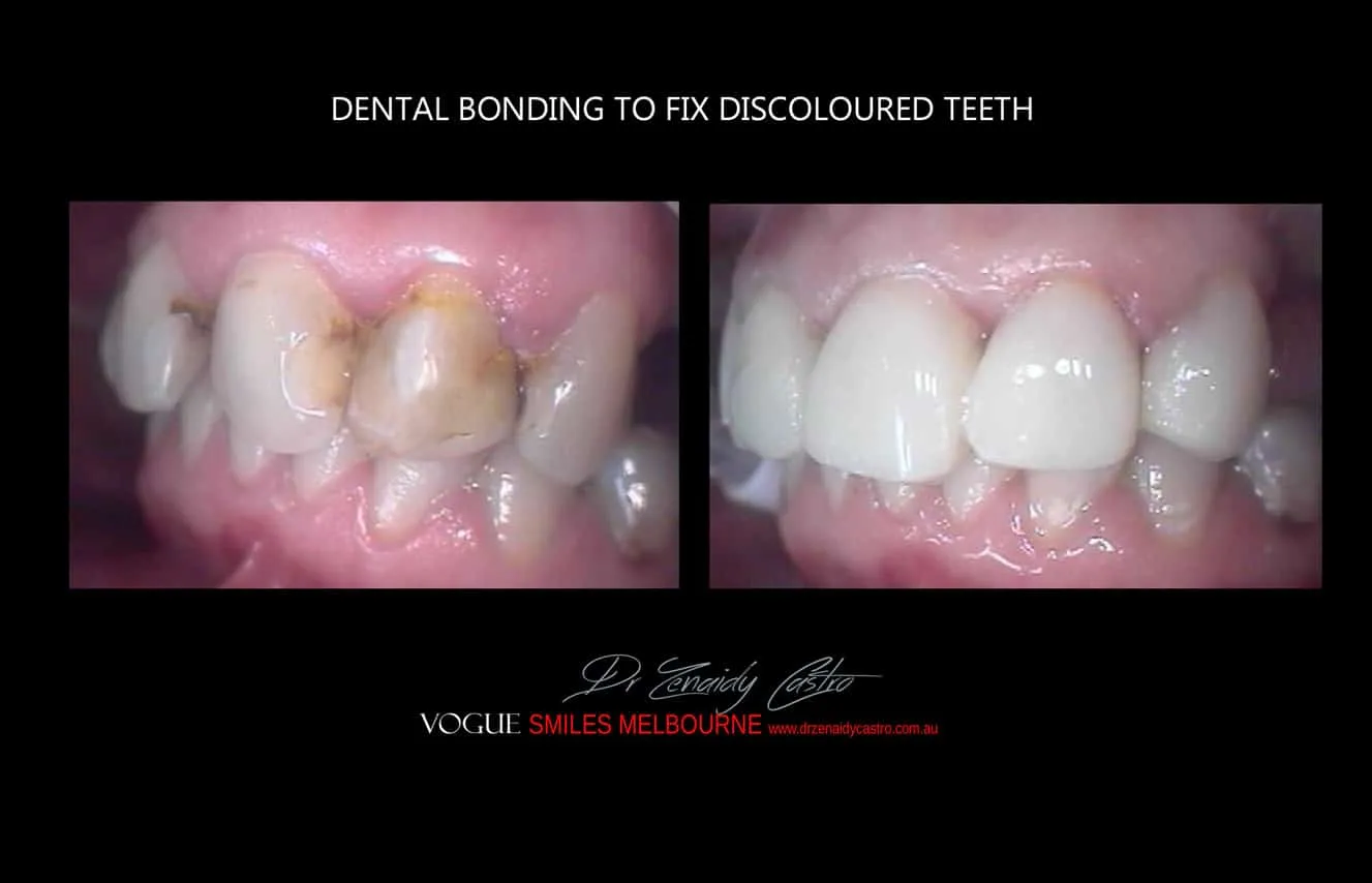 Is there a cheaper option than veneers?- Composite Veneers, Dental Bonding Melbourne CBD and Noble Park North