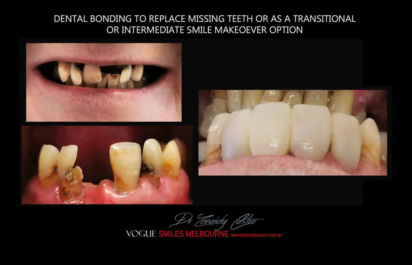 Is there a cheaper option than veneers?- Composite Veneers, Dental Bonding Melbourne CBD and Noble Park North