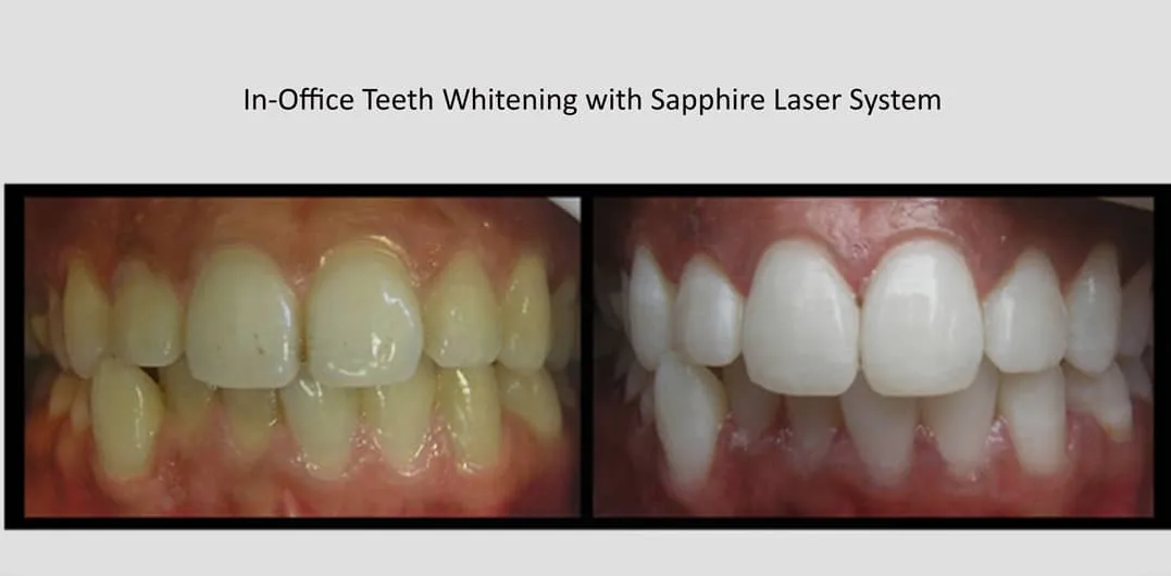 ZOOM! Zoom Teeth Whitening Melbourne -Zoom In-Chair Teeth Whitening Melbourne CBD Dentist