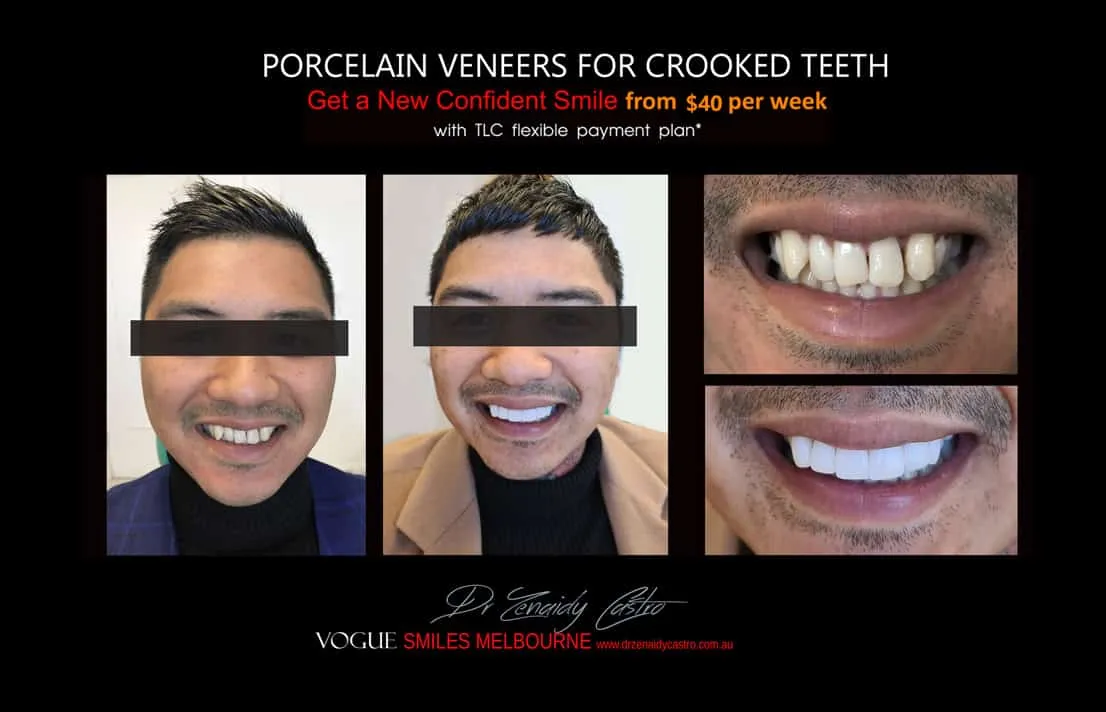 Fastest way to straighten teeth Without Braces in Melbourne, fastest teeth straightening without braces Melbourne CBD City 3000 Victoria Australia