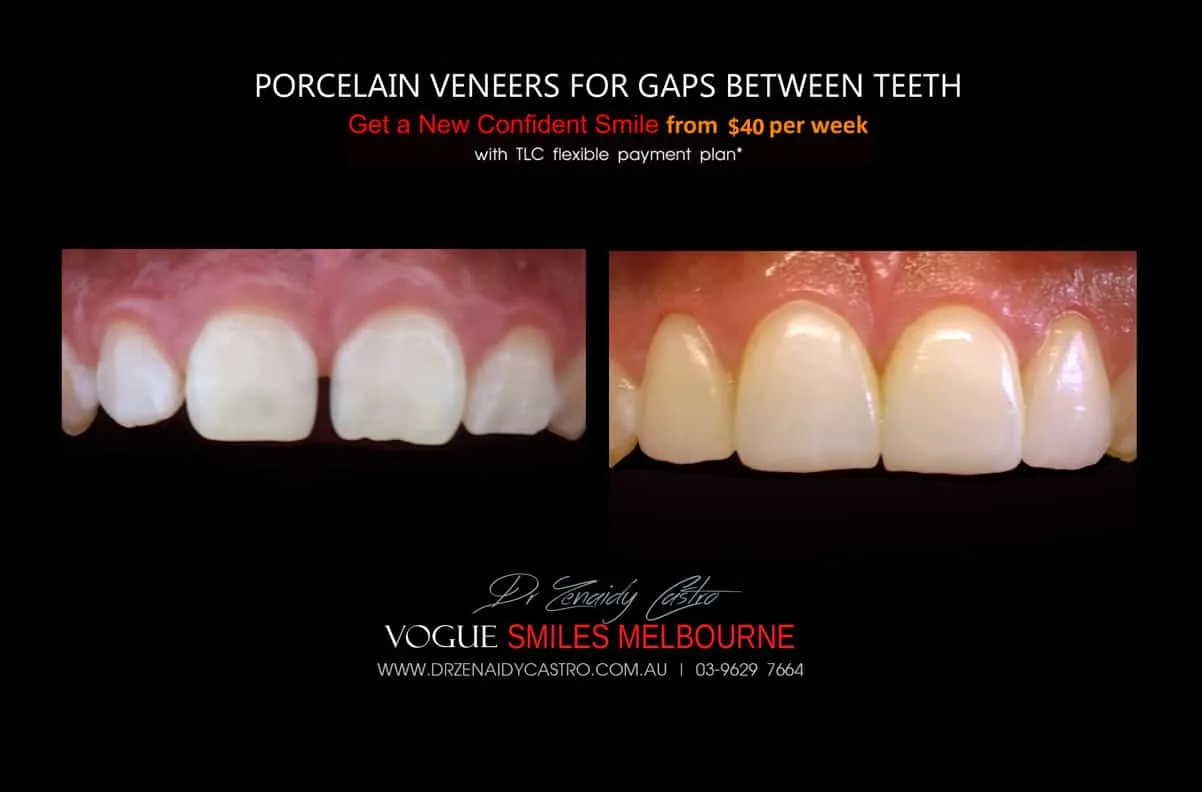 Close Gaps and Spaces between Front Teeth with Porcelain Veneer- Top cosmetic dentist in Melbourne