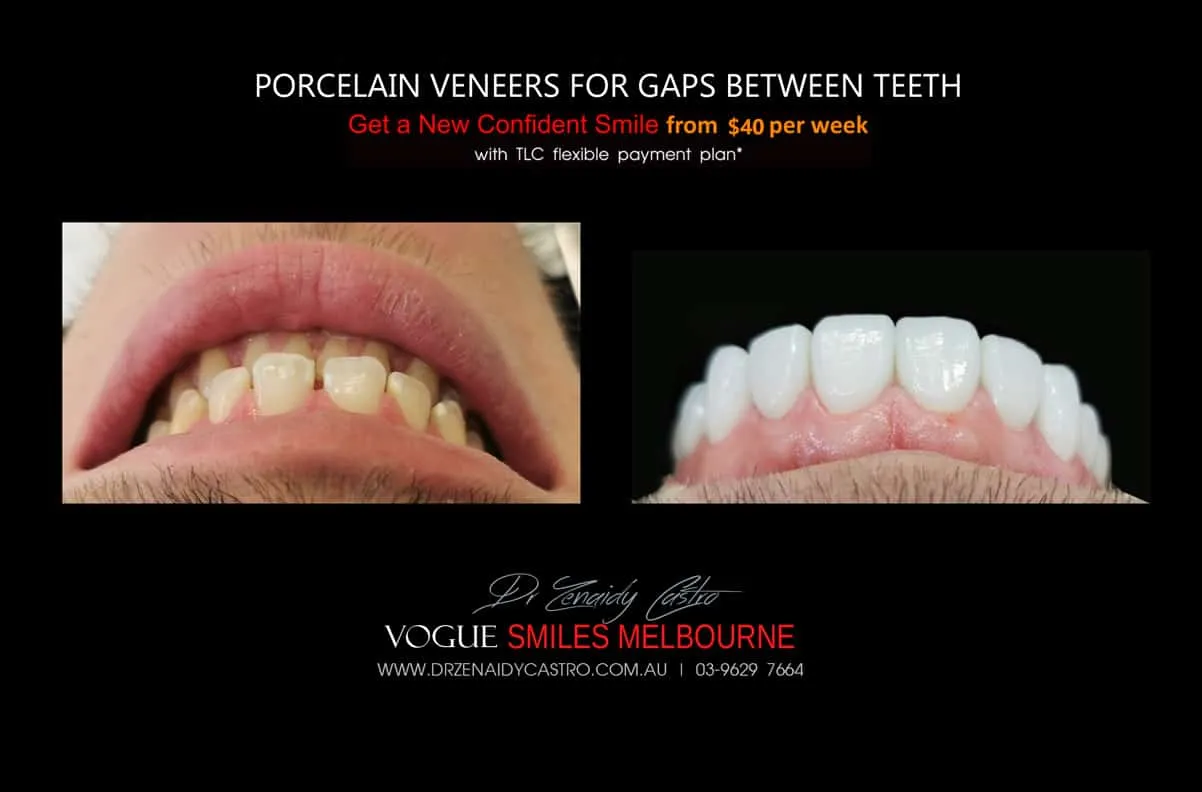 Close Gaps and Spaces between Front Teeth with Porcelain Veneer- Top cosmetic dentist in Melbourne