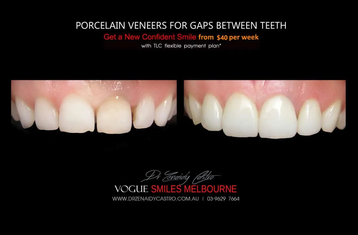 Close Gaps and Spaces between Front Teeth with Porcelain Veneer- Top cosmetic dentist in Melbourne