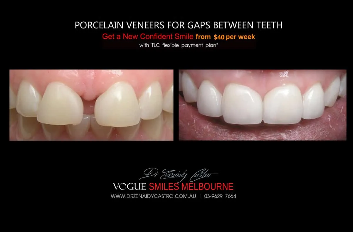 Close Gaps and Spaces between Front Teeth with Porcelain Veneer- Top cosmetic dentist in Melbourne