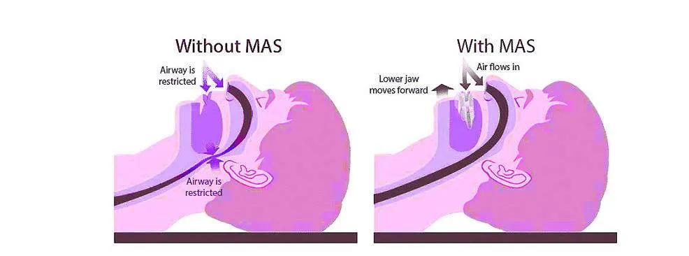 SNORING TREATMENT MELBOURNE Mandibular Advancement Device 